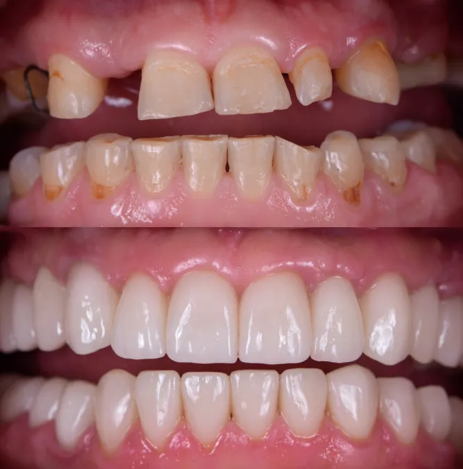 Before and After smile transformation at 1st Impressions Orthodontics in Westminster, CO
