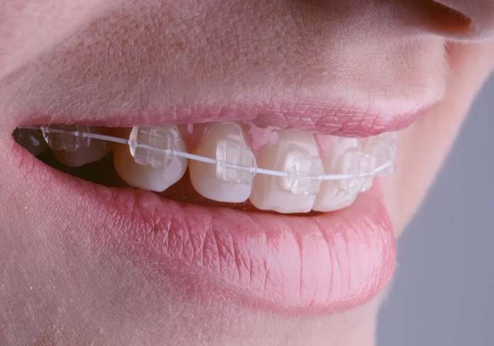 Braces showcase at 1st Impressions Orthodontics in Westminster, CO