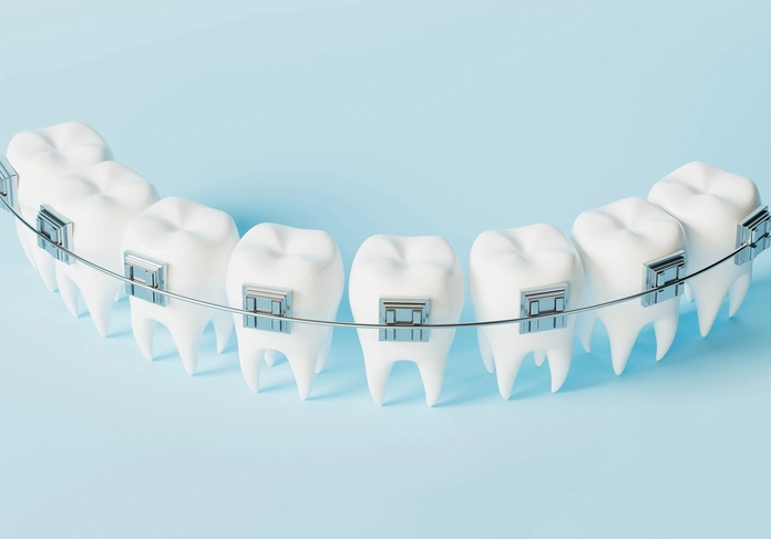 Braces showcase at 1st Impressions Orthodontics in Westminster, CO