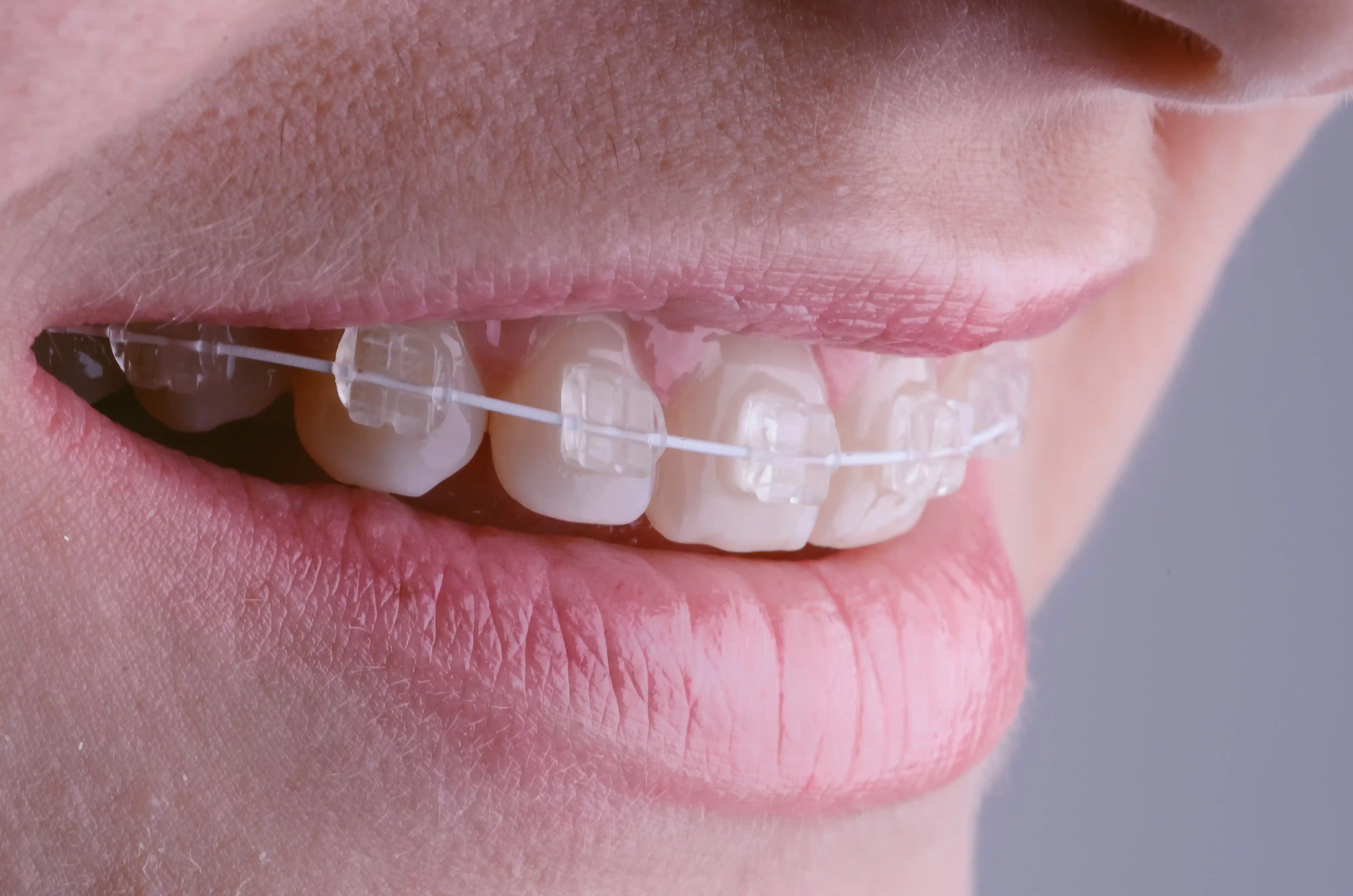 What are braces at 1st Impressions Orthodontics in Westminster, CO