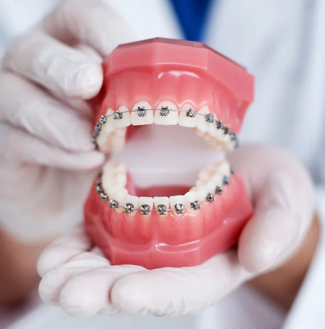Braces treatment process at 1st Impressions Orthodontics in Westminster, CO