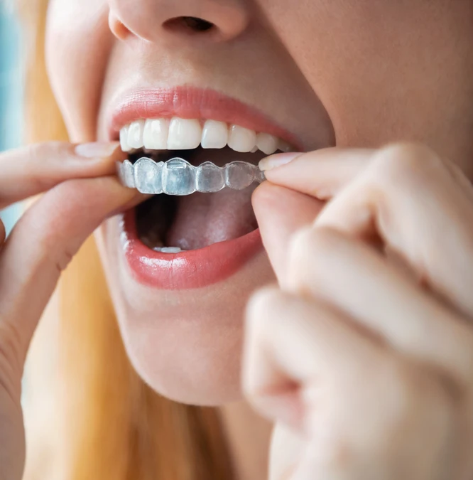 Invisalign treatment process at 1st Impressions Orthodontics in Westminster, CO