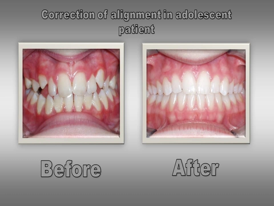 Before and After
