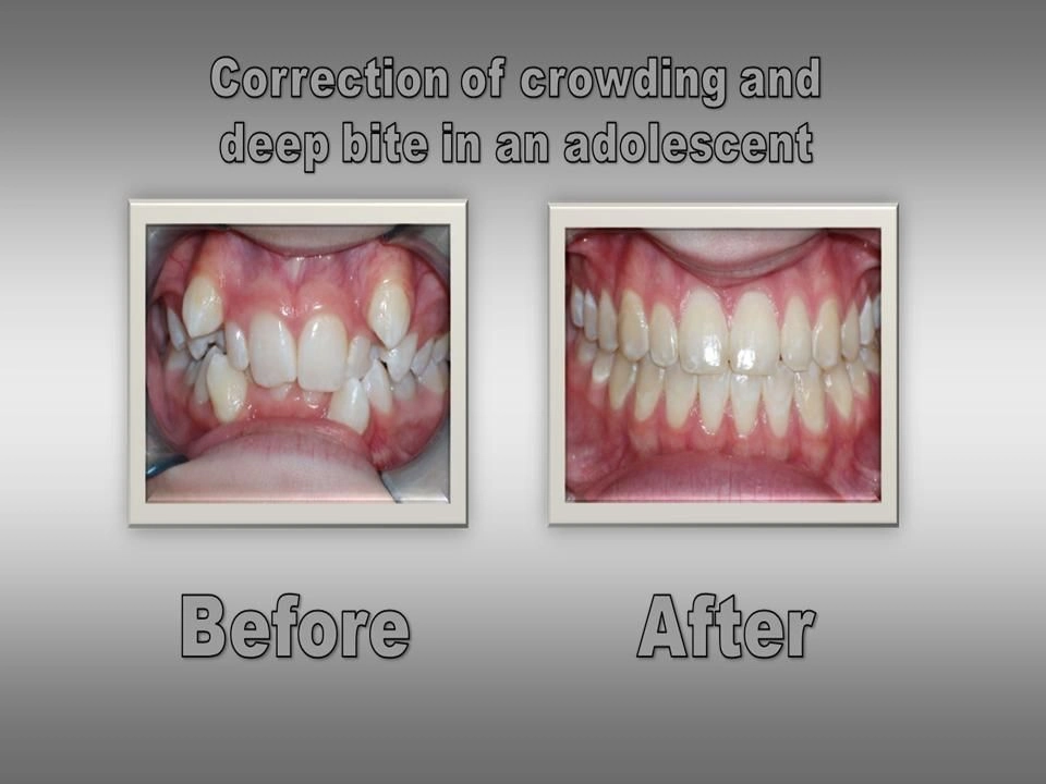 Before and After