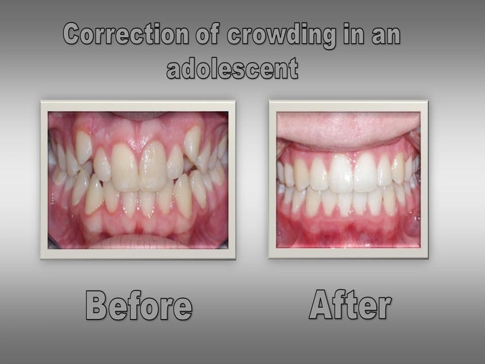 Before and After